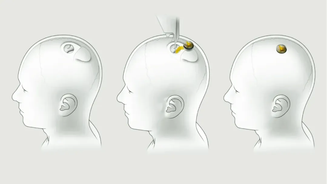 成为网红，马斯克Neuralink脑机接口植入者上线表演意念发帖