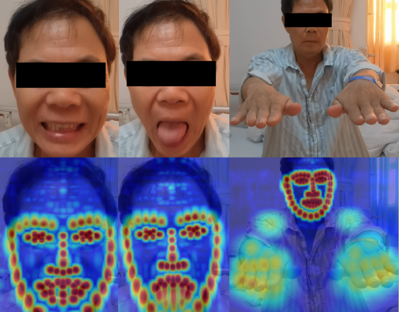 20岁本科生获多所全美Top50博士offer,研发非接触AI工具精准预判中风,准确率超91%