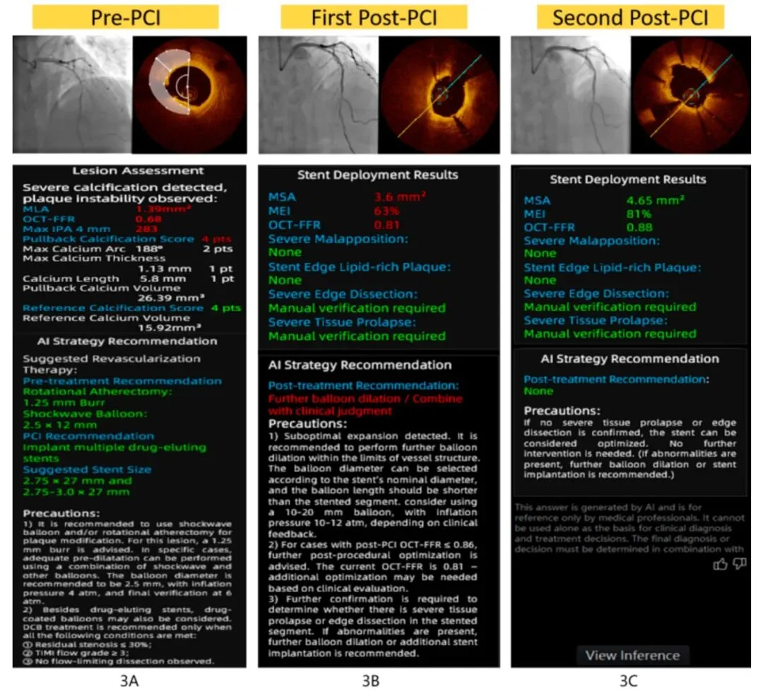 临床PK完胜ChatGPT-5!国内团队造出首个OCT影像AI系统