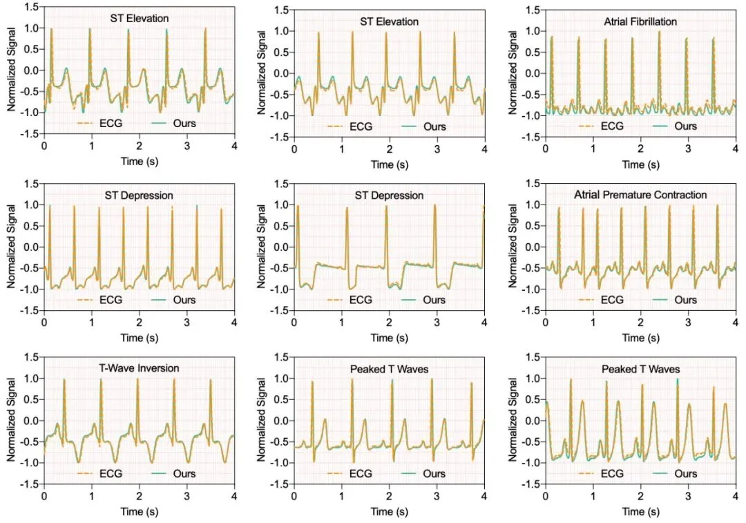 清华朱军团队Nature Machine Intelligence：多模态扩散模型实现心血管信号实时全面监测
