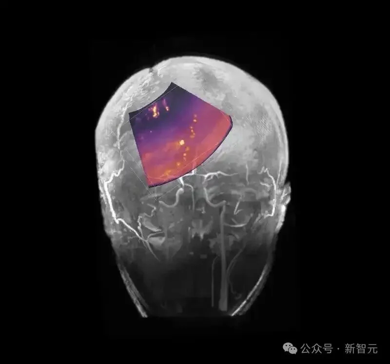 马斯克「脑机第一人」首爆！不开颅在线升级，永生代码已写入