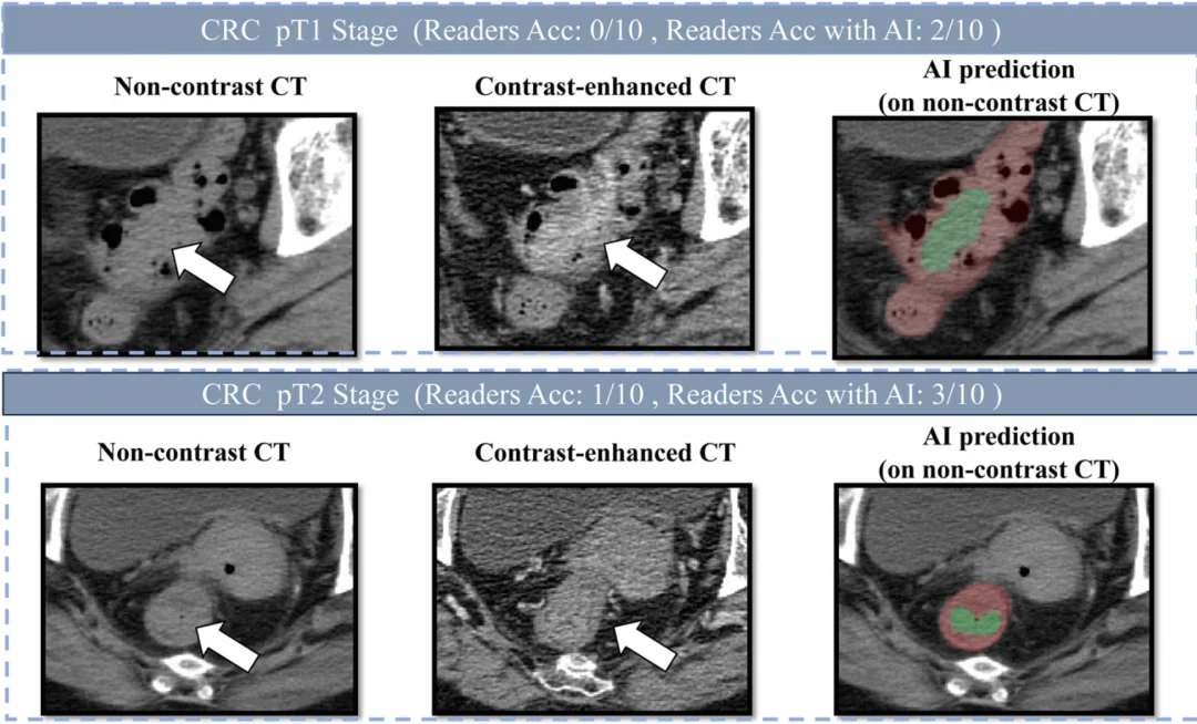 三年连下三癌，阿里AI跑通了多癌筛查